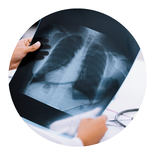 Stress Chest X-Ray in Mohali