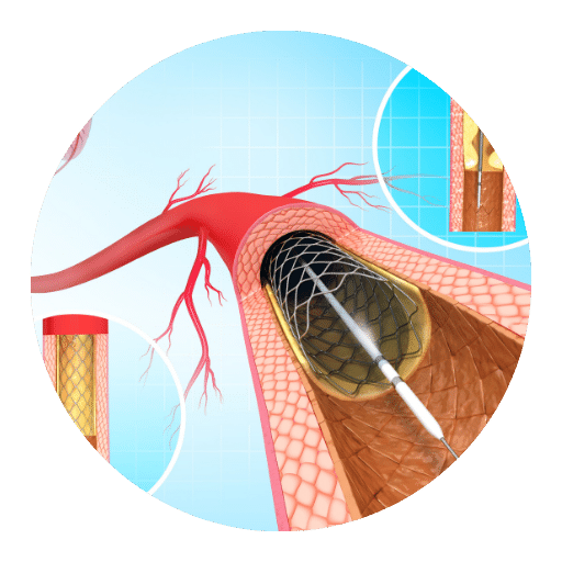 Coronary Angioplasty in Mohali