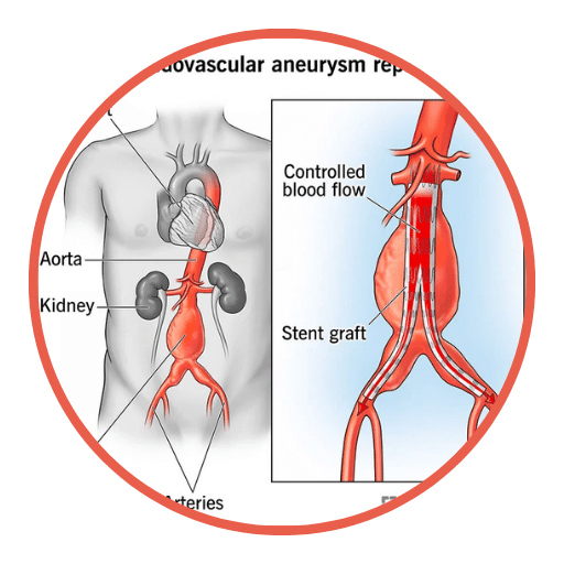 EVAR Aortic Aneurysm Repair