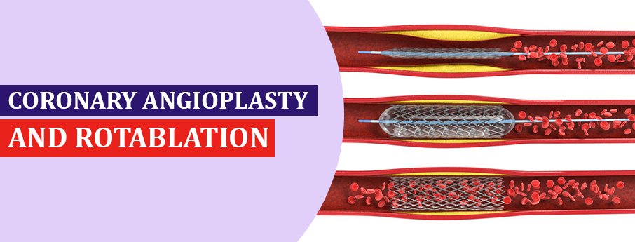 Visual representation of coronary angiography and rotablation procedure at ACE Heart and Vascular Institute, Mohali.