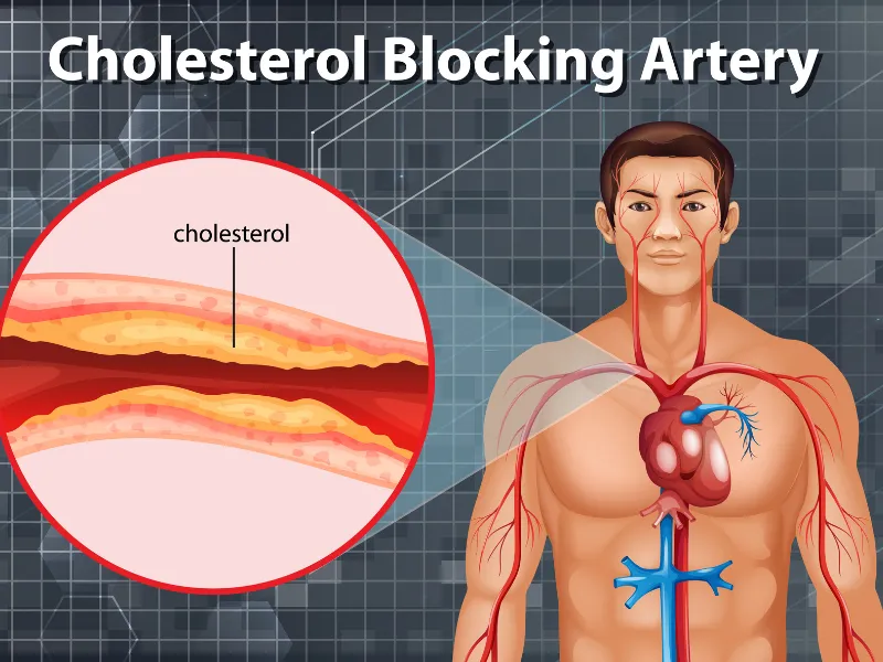 How Does Plaque Build Up in the Arteries?
